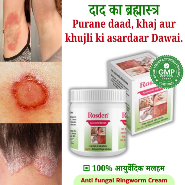 Rosden Malam – Ayurvedic Ointment for Itching, Skin Infection & Fast Relief